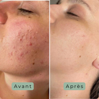 Cutalys - Spray Acné Solution