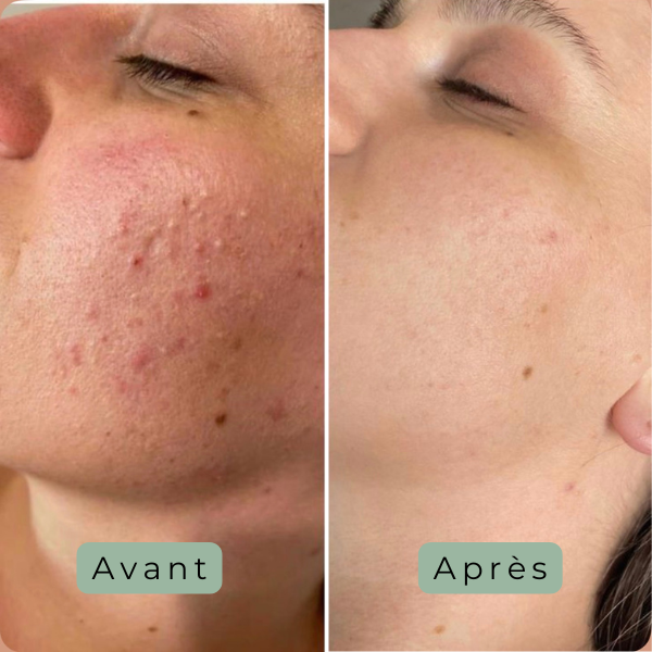 Cutalys - Spray Acné Solution
