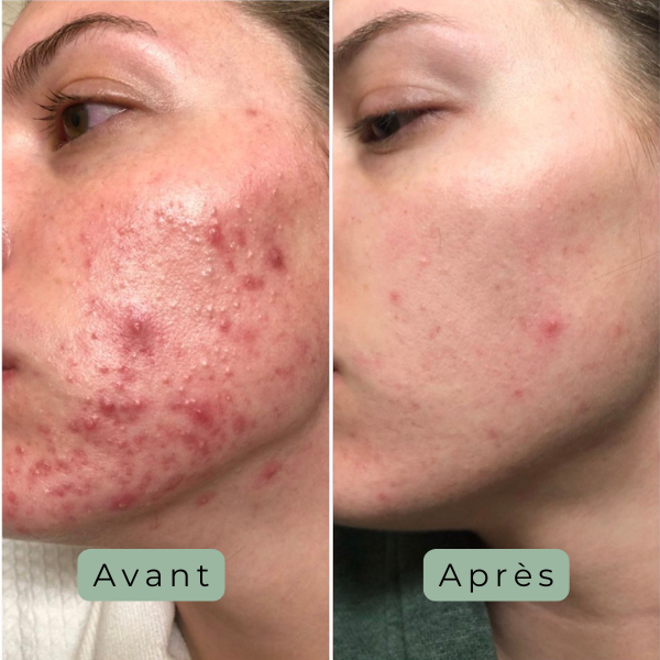 Cutalys - Spray Acné Solution