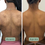 Cutalys - Spray Acné Solution