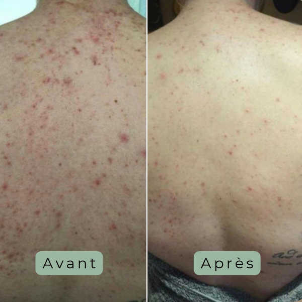 Cutalys - Spray Acné Solution