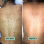 Cutalys - Spray Acné Solution