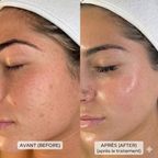 Cutalys - Spray Acné Solution